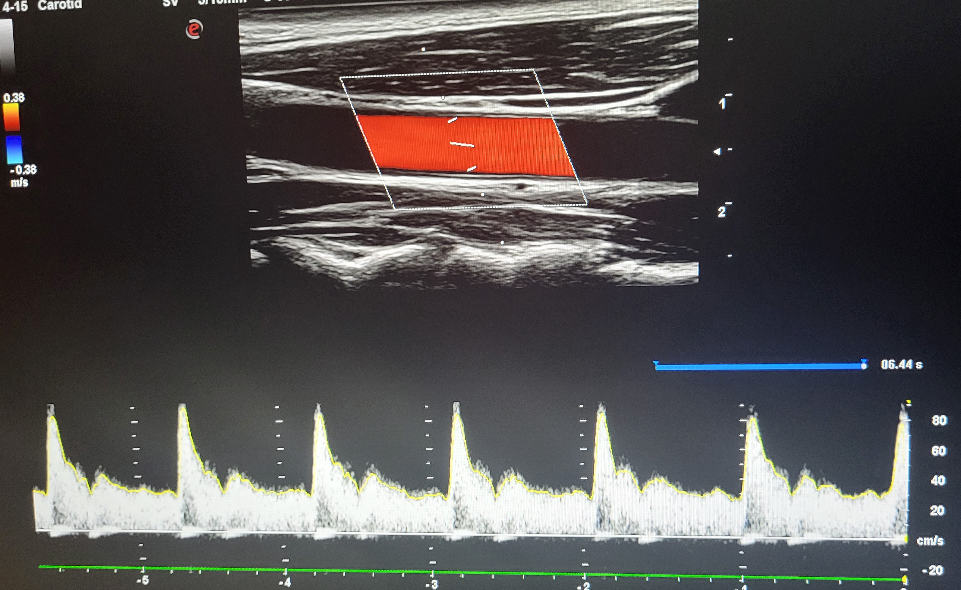 Carotid Blood Flow